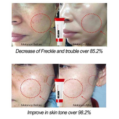 Medi-Peel Melanon X 30mL ครีมฝ้ากระ ที่ฮอตมากๆ ในเกาหลี นิยมใช้ในคลีนิคและสปาผิวของเกาหลีค่ะ