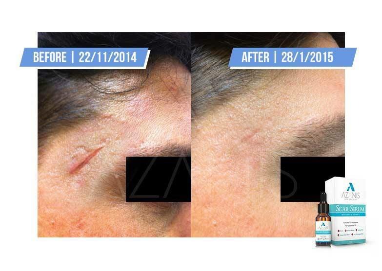 AZANIS SCAR SERUM แท้100%