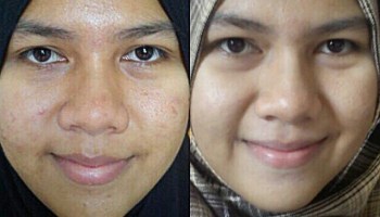AZANIS SCAR SERUM แท้100%