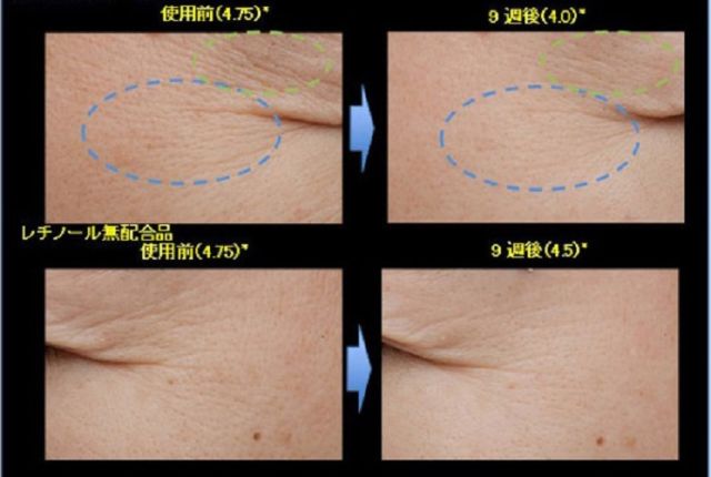 Shiseido Elixir Retinol Power Wrinkle Smoothing Cream 15g ครีมที่เน้นการเติมเต็มริ้วรอยแห่งวัย โดยใช้ส่วนผสมจากเรตินอล ช่วยกระชับผิว และลดเลือนริ้วรอยให้จางลงอย่างเห็นได้ชัด