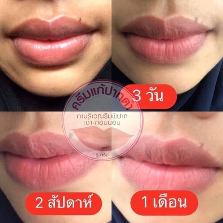 ครีมแก้ปากดำ คลินิค ลิปแก้ปากดำ