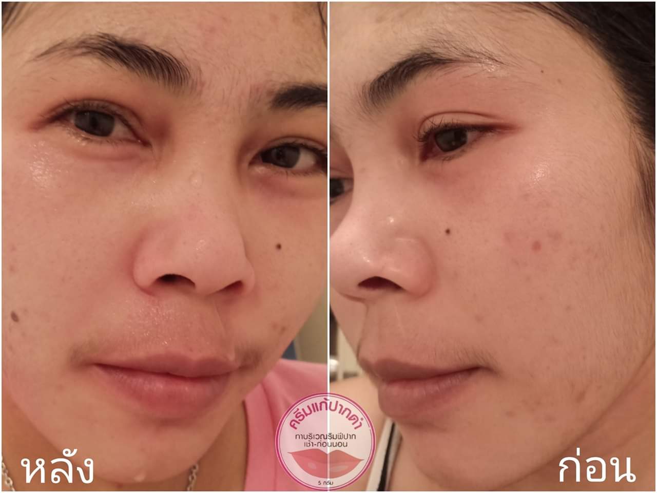 ครีมแก้ปากดำ คลินิค ลิปแก้ปากดำ