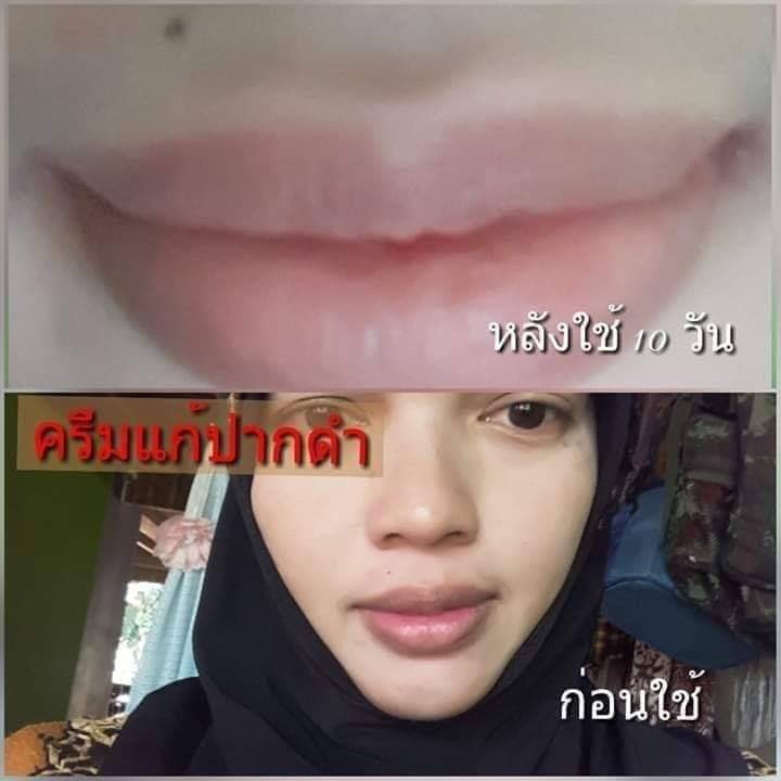ครีมแก้ปากดำ คลินิค ลิปแก้ปากดำ