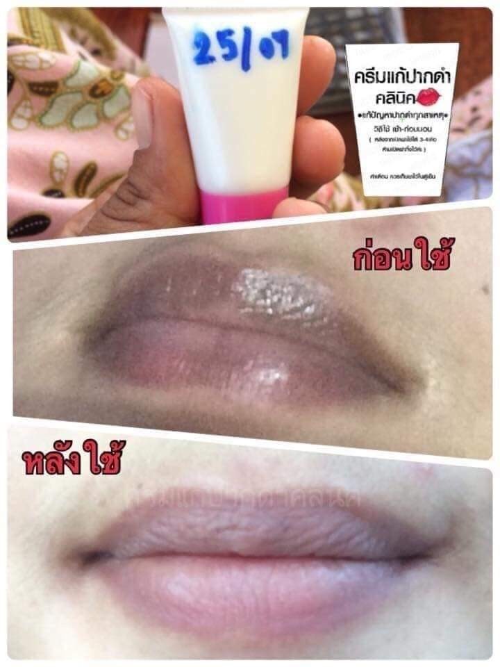 ครีมแก้ปากดำ คลินิค ลิปแก้ปากดำ