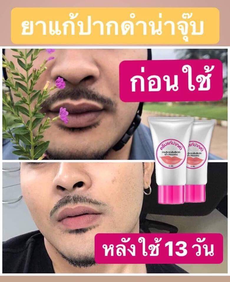 ครีมแก้ปากดำ คลินิค ลิปแก้ปากดำ