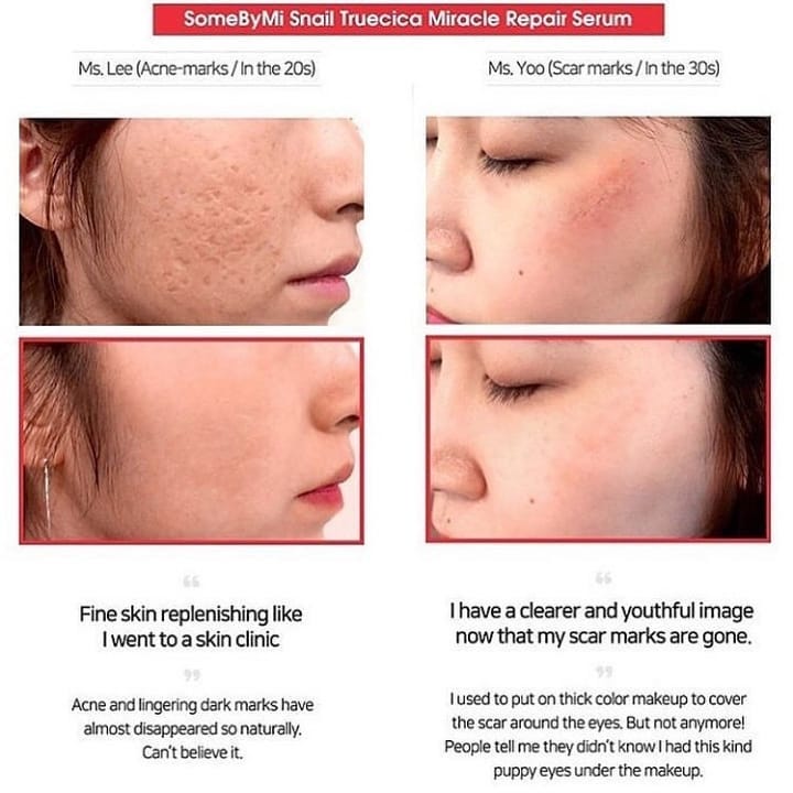(เรทขายส่งด้านใน) Some by Mi Snail Truecica Miracle Repair Serum 50mL เซรั่มสกัดหอยทาก ลดรอยสิว รอบแผลเป็น บรรเทาหลุมสิว เสกผิวกลับมาให้เรียบเนียน กระจ่างใสยิ่งขึ้น