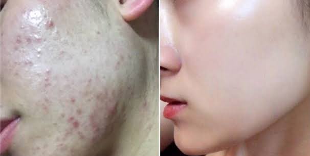 ขายส่ง 75.-/80.-(พร้อมส่ง) Bearoban Ointment 10g ครีมทาแผลเป็นตัวดังจากเกาหลี ช่วยสมานแผล ลดรอยสิว รอยแผลเป็น รอยแผลศัลยกรรมจางได้อย่างดี รีวิวเพียบเพราะหมอศัลย์ที่เกาหลีแนะนำค่ะ