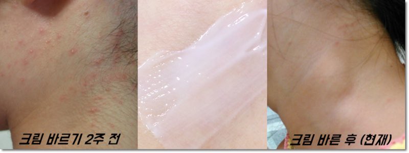 ขายส่ง 75.-/80.-(พร้อมส่ง) Bearoban Ointment 10g ครีมทาแผลเป็นตัวดังจากเกาหลี ช่วยสมานแผล ลดรอยสิว รอยแผลเป็น รอยแผลศัลยกรรมจางได้อย่างดี รีวิวเพียบเพราะหมอศัลย์ที่เกาหลีแนะนำค่ะ