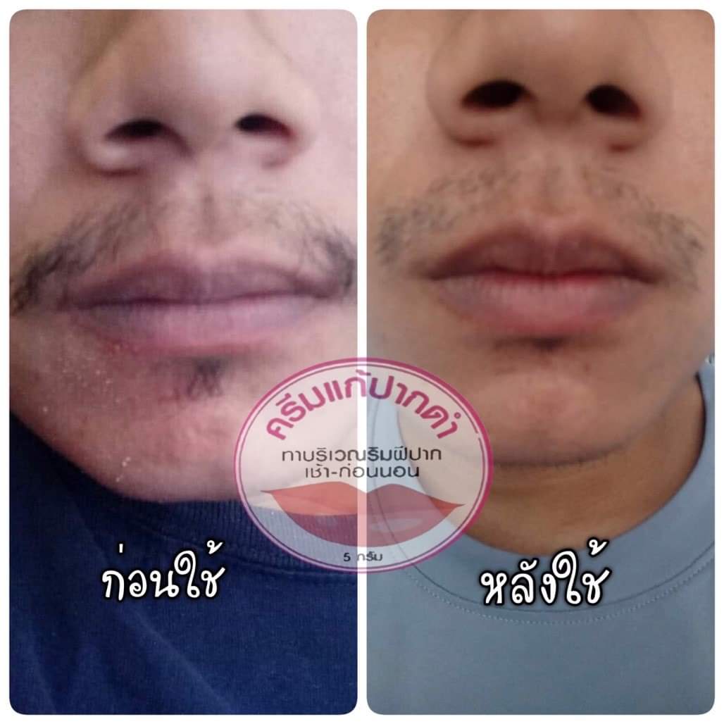ครีมแก้ปากดำ คลินิค ลิปแก้ปากดำ