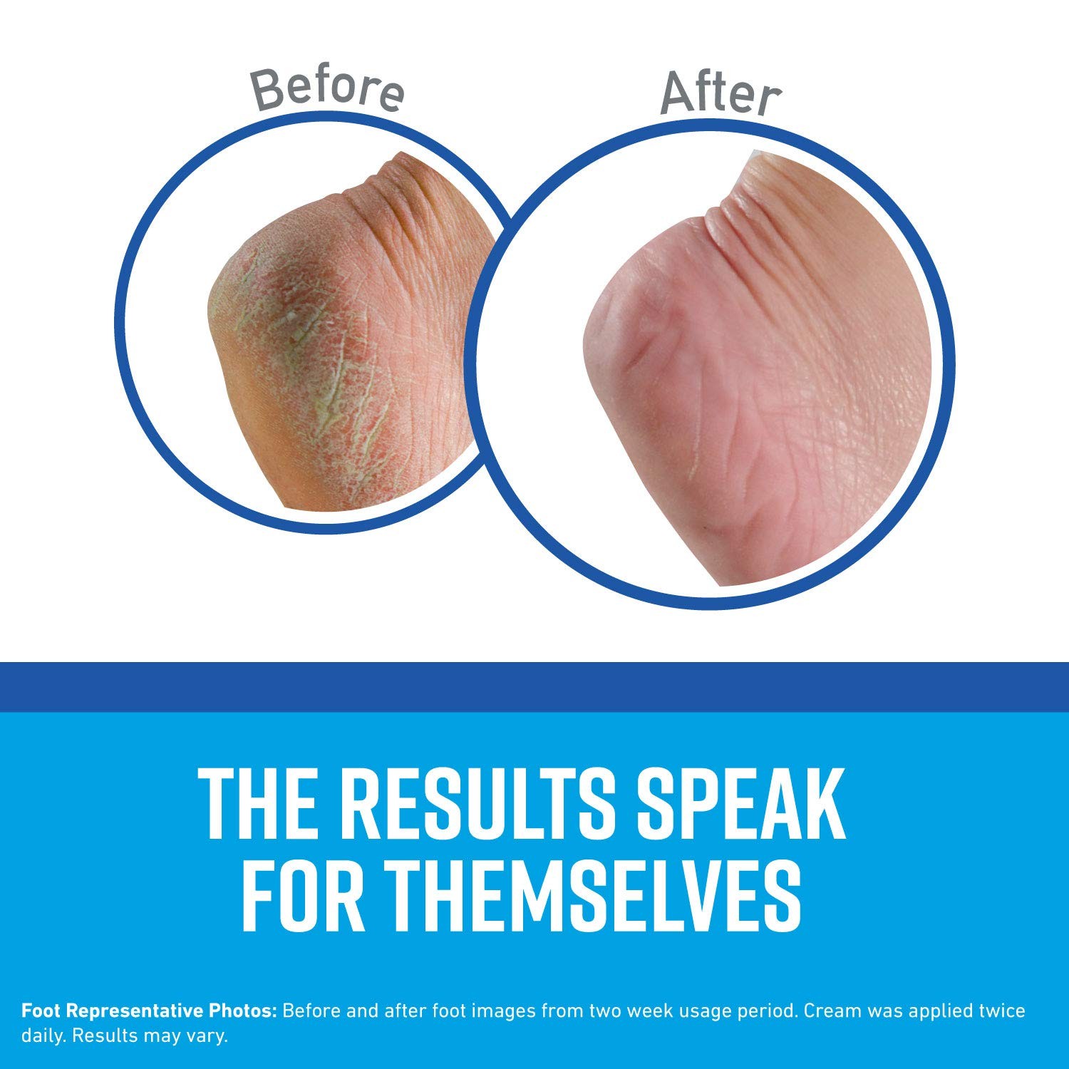 ครีมบรรเทาอาการส้นเท้าแตก O'KEEFFE'S For HEALTHY FEET Foot Cream