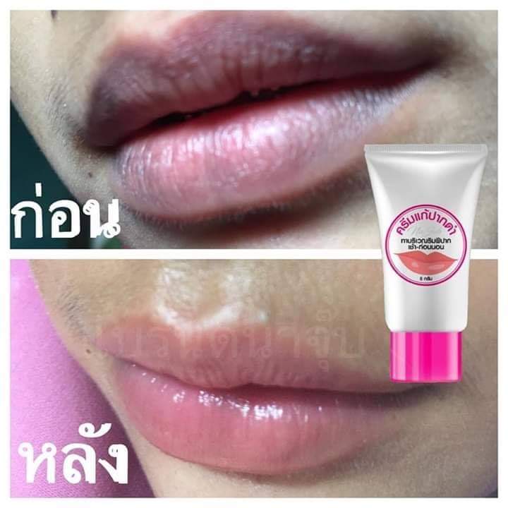 ครีมแก้ปากดำ คลินิค ลิปแก้ปากดำ