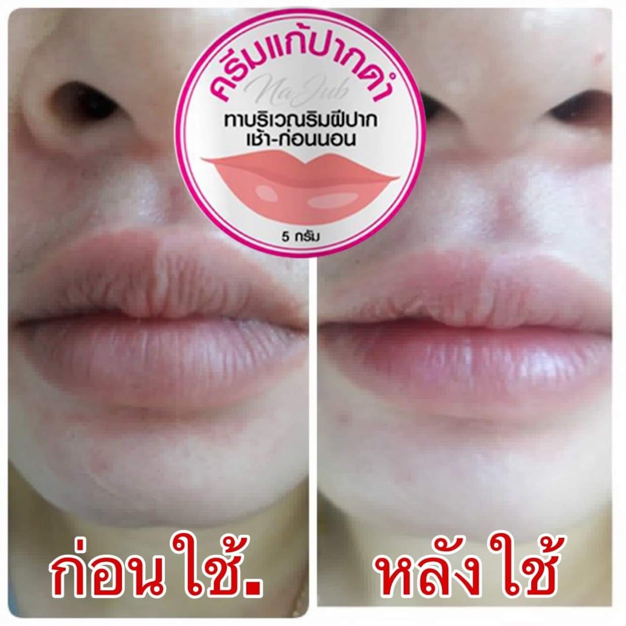 ครีมแก้ปากดำ คลินิค ลิปแก้ปากดำ