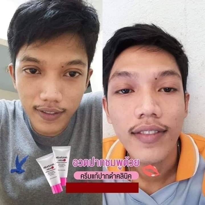 ครีมแก้ปากดำ คลินิค ลิปแก้ปากดำ