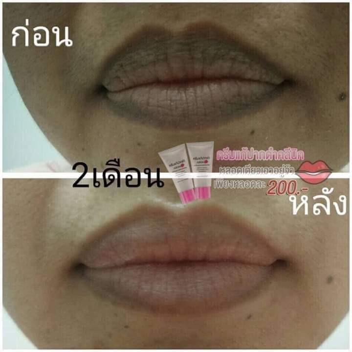 ครีมแก้ปากดำ คลินิค ลิปแก้ปากดำ