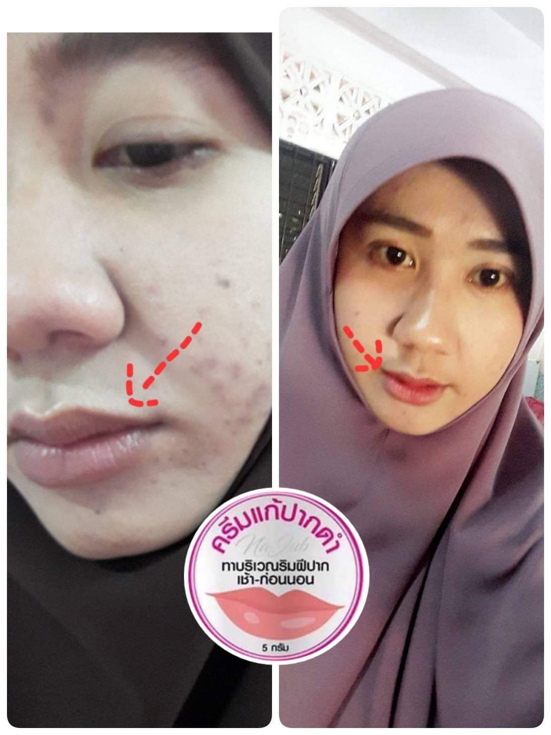 ครีมแก้ปากดำ คลินิค ลิปแก้ปากดำ