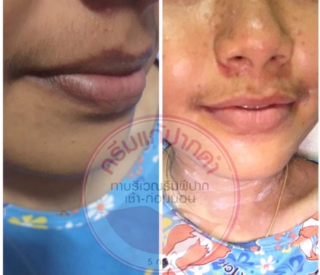 ครีมแก้ปากดำ คลินิค ลิปแก้ปากดำ