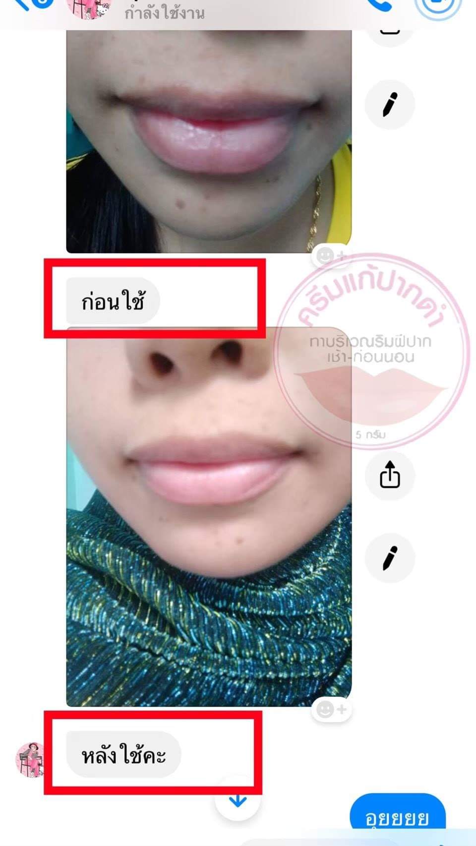 ครีมแก้ปากดำ คลินิค ลิปแก้ปากดำ