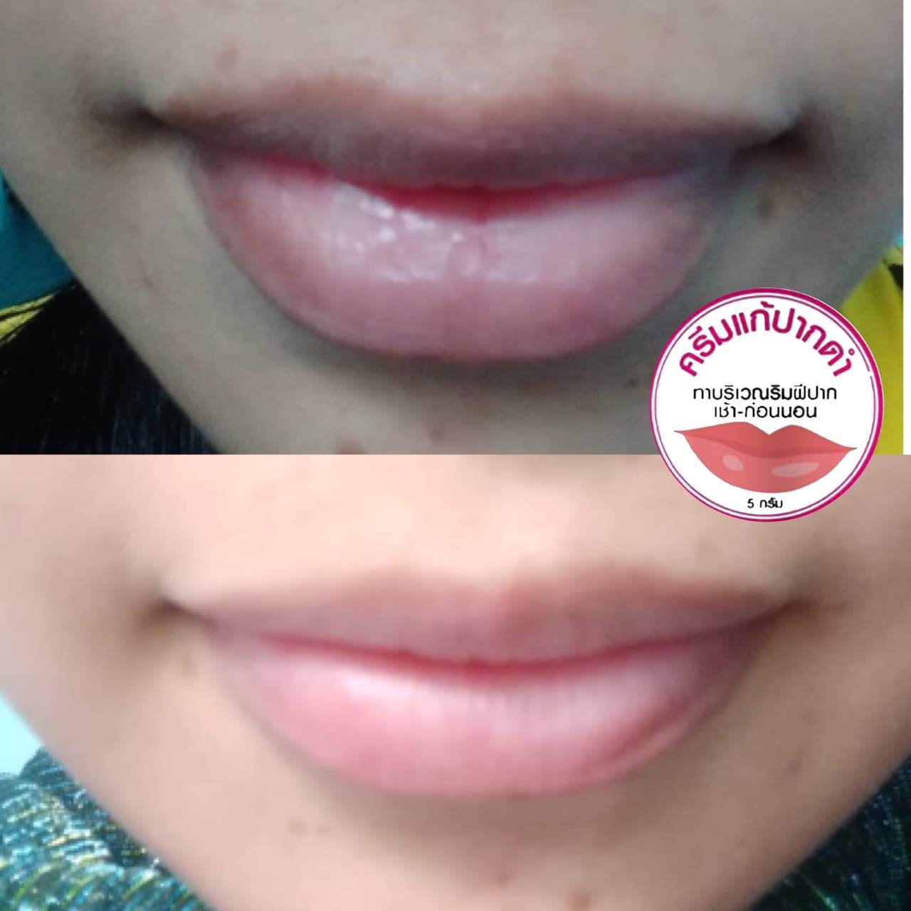 ครีมแก้ปากดำ คลินิค ลิปแก้ปากดำ
