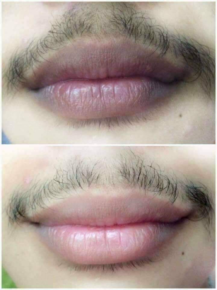 ครีมแก้ปากดำ คลินิค ลิปแก้ปากดำ