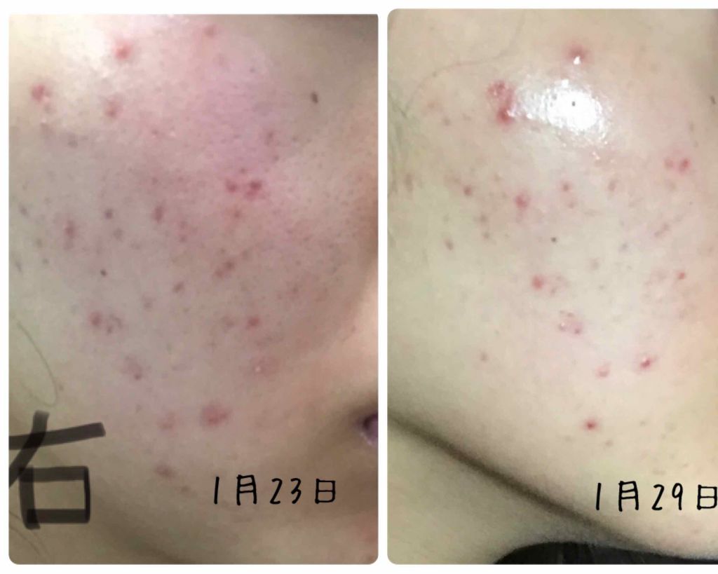 DHC Cleacnea AC 30 Days อาหารเสริมเพือผิวเป็นสิวโดยเฉพาะ เหมาะกับผู้มีปัญหาผิวมัน ให้ผิวสมดุลชุ่มชื้น