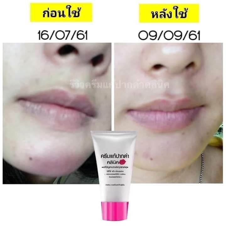 ครีมแก้ปากดำ คลินิค ลิปแก้ปากดำ