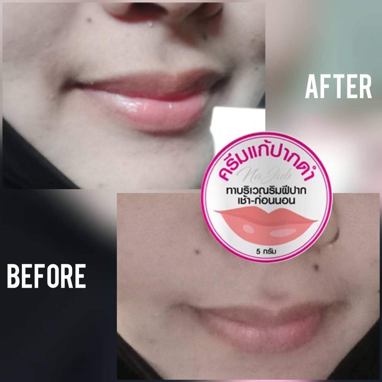 ครีมแก้ปากดำ คลินิค ลิปแก้ปากดำ