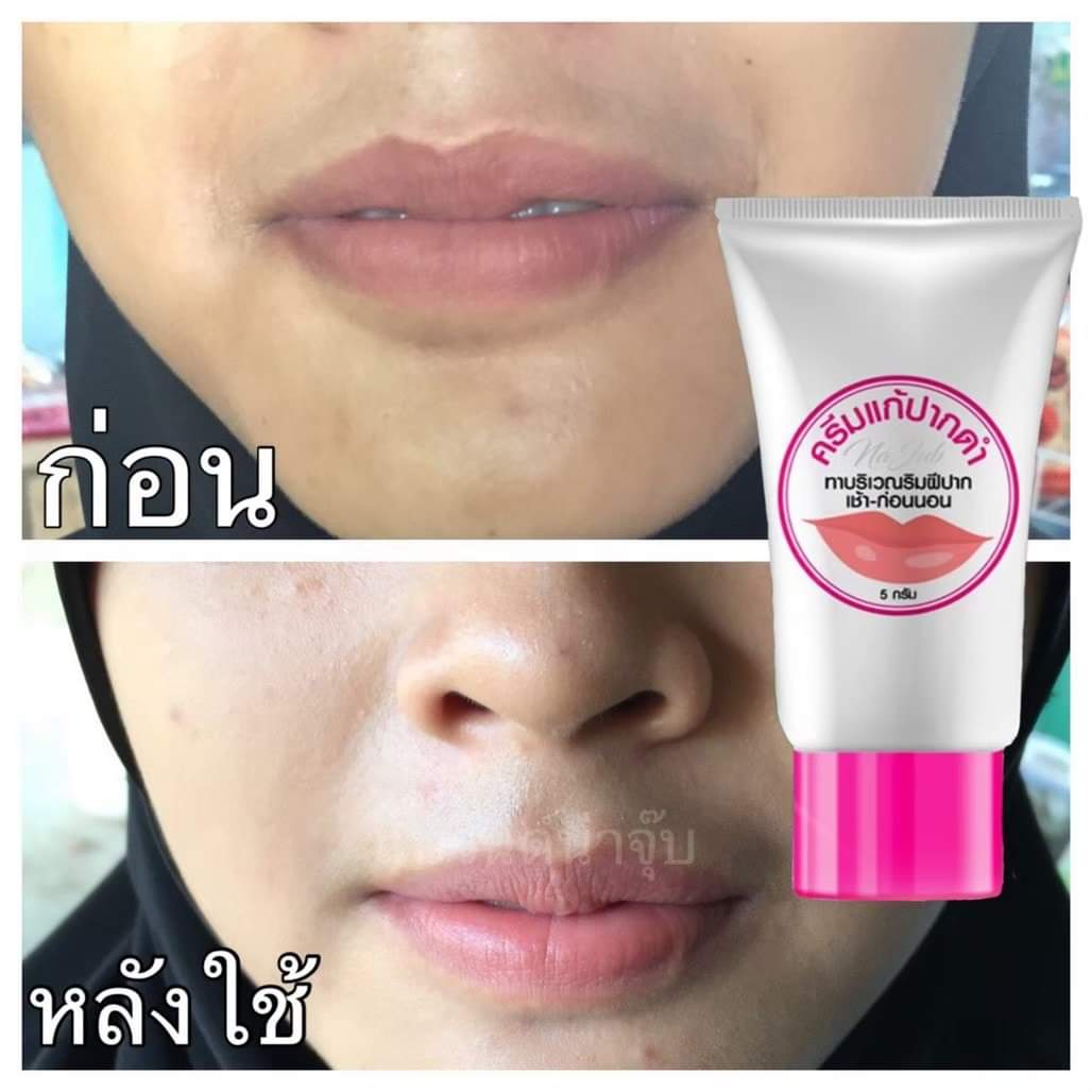 ครีมแก้ปากดำ คลินิค ลิปแก้ปากดำ