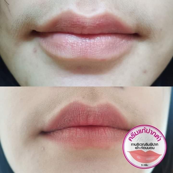 ครีมแก้ปากดำ คลินิค ลิปแก้ปากดำ