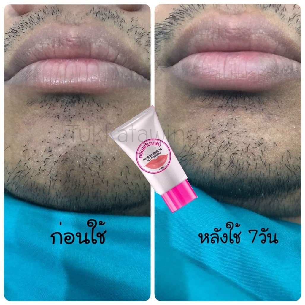 ครีมแก้ปากดำ คลินิค ลิปแก้ปากดำ