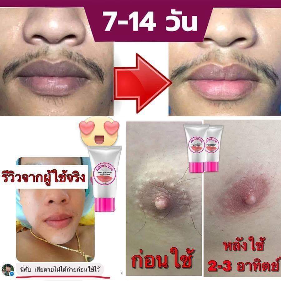 ครีมแก้ปากดำ คลินิค ลิปแก้ปากดำ