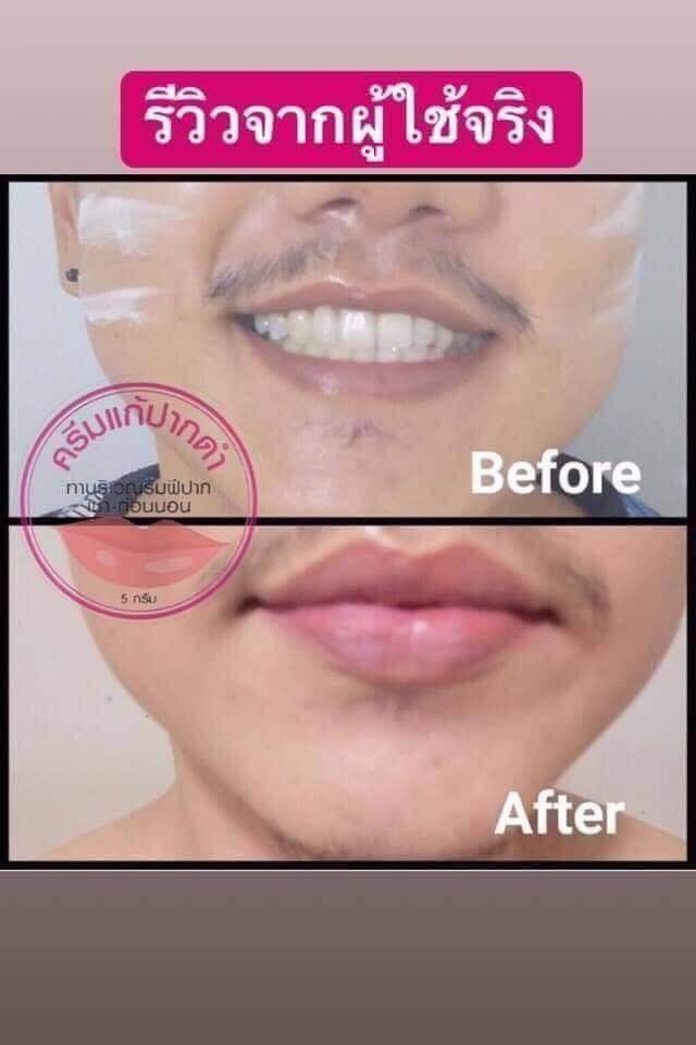 ครีมแก้ปากดำ คลินิค ลิปแก้ปากดำ