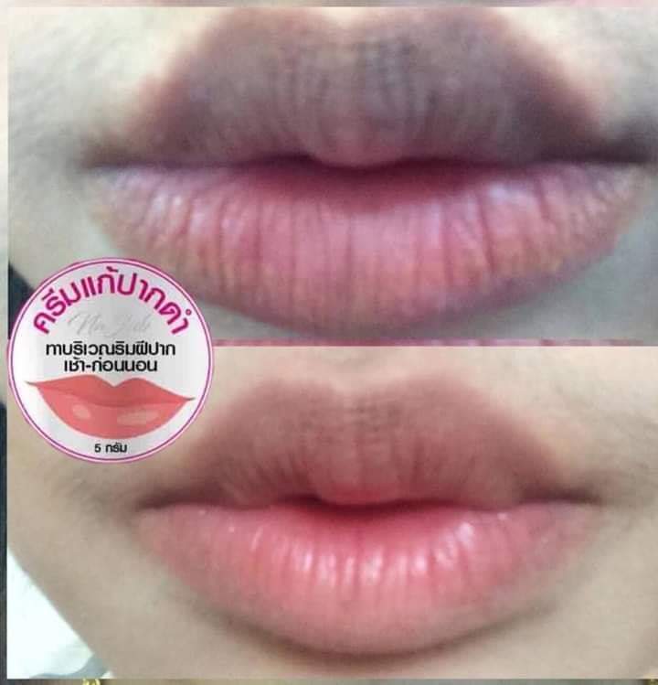 ครีมแก้ปากดำ คลินิค ลิปแก้ปากดำ