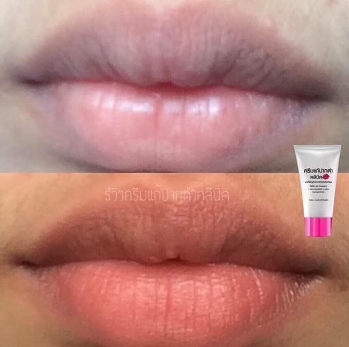 ครีมแก้ปากดำ คลินิค ลิปแก้ปากดำ