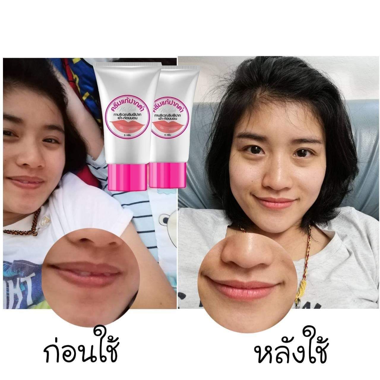 ครีมแก้ปากดำ คลินิค ลิปแก้ปากดำ