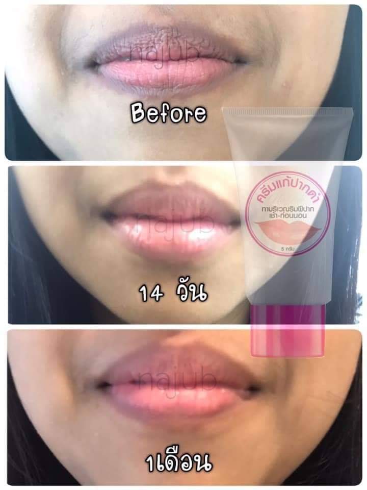 ครีมแก้ปากดำ คลินิค ลิปแก้ปากดำ