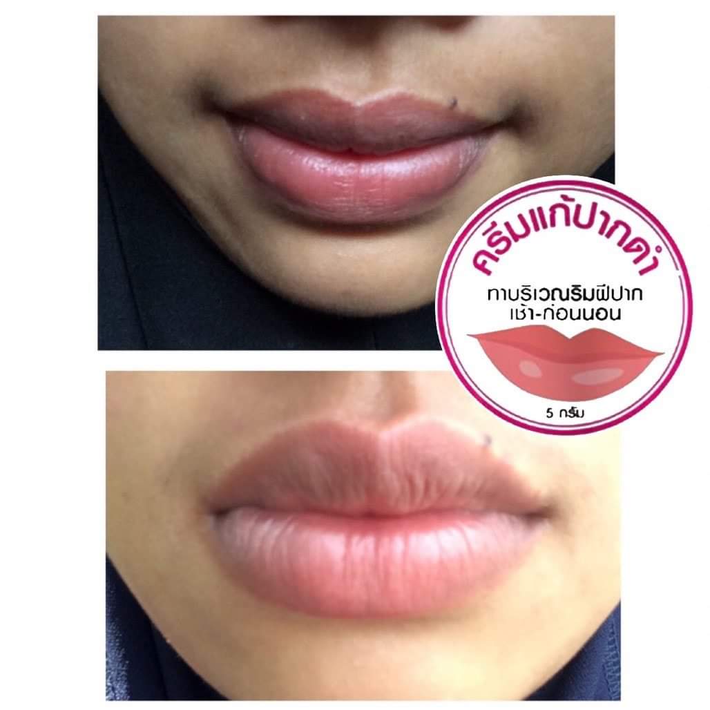 ครีมแก้ปากดำ คลินิค ลิปแก้ปากดำ