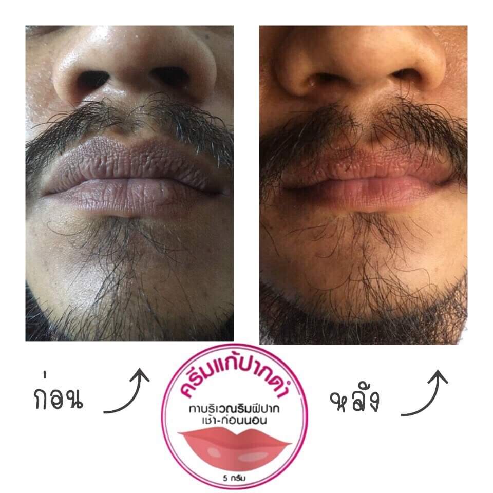 ครีมแก้ปากดำ คลินิค ลิปแก้ปากดำ