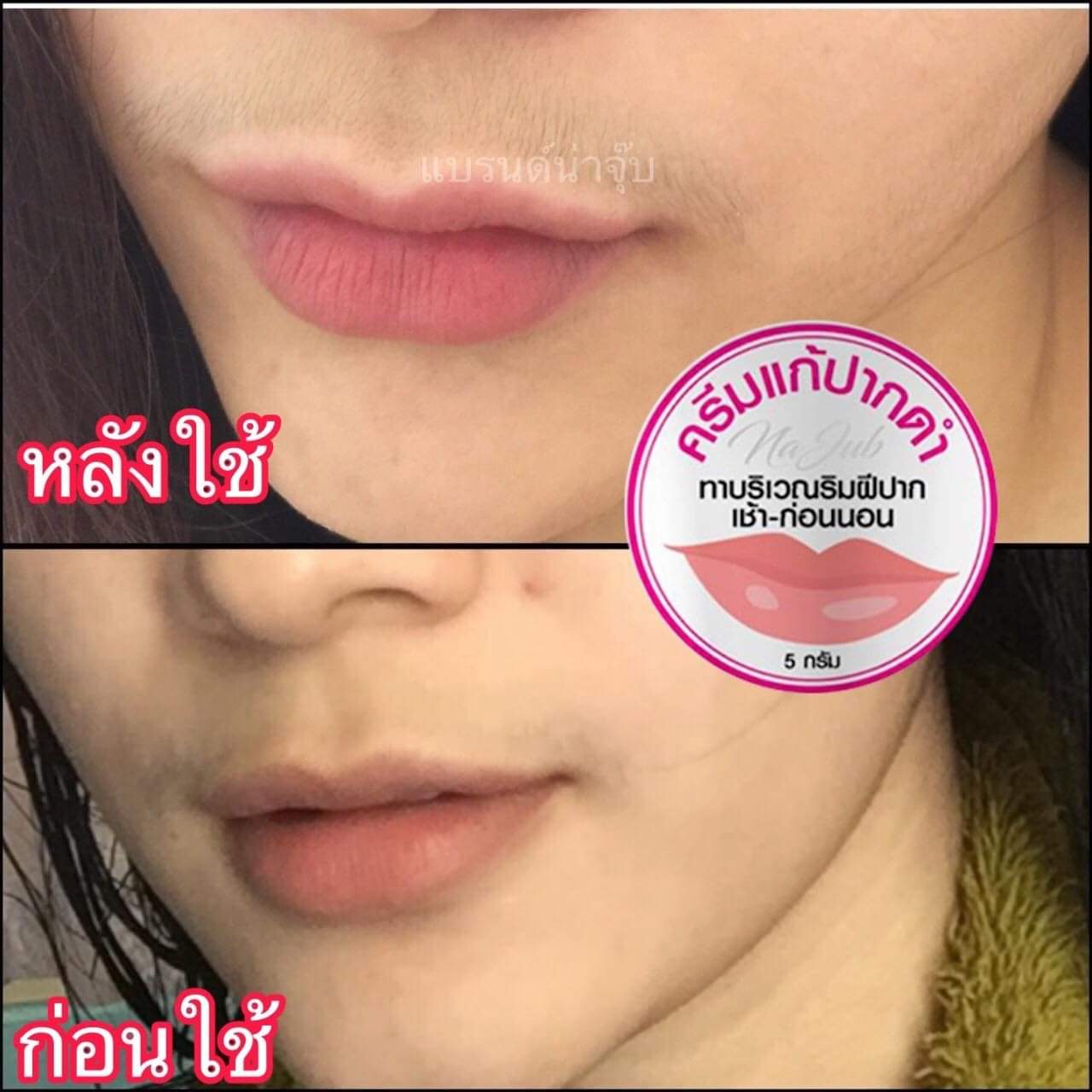 ครีมแก้ปากดำ คลินิค ลิปแก้ปากดำ