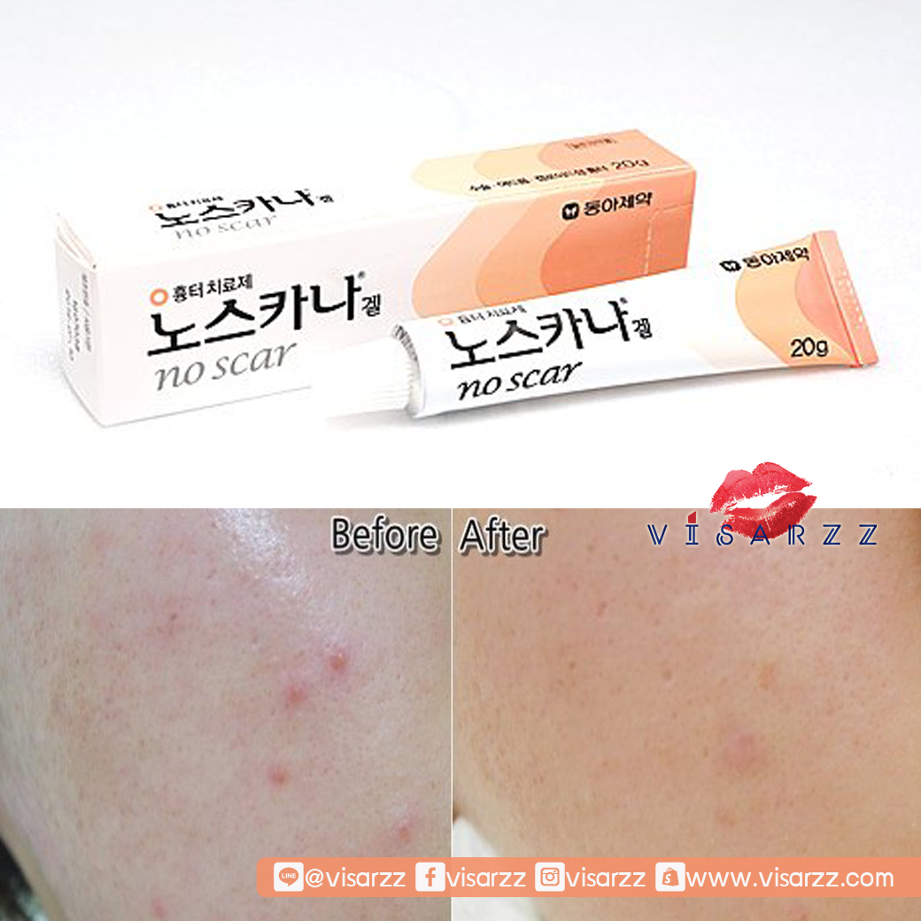 Noscarna Gel 20g ครีมทารักษารอยแผลเป็น รอยแดง รอยดำที่เกิดจากสิว ตัวนี้คนเกาหลีฮิตมากกก รีวิวเยอะมาก ใช้ดีมากๆ รอยหายเกลี้ยง ตัวนี้ดังมาก รีวิวเพียบเลย