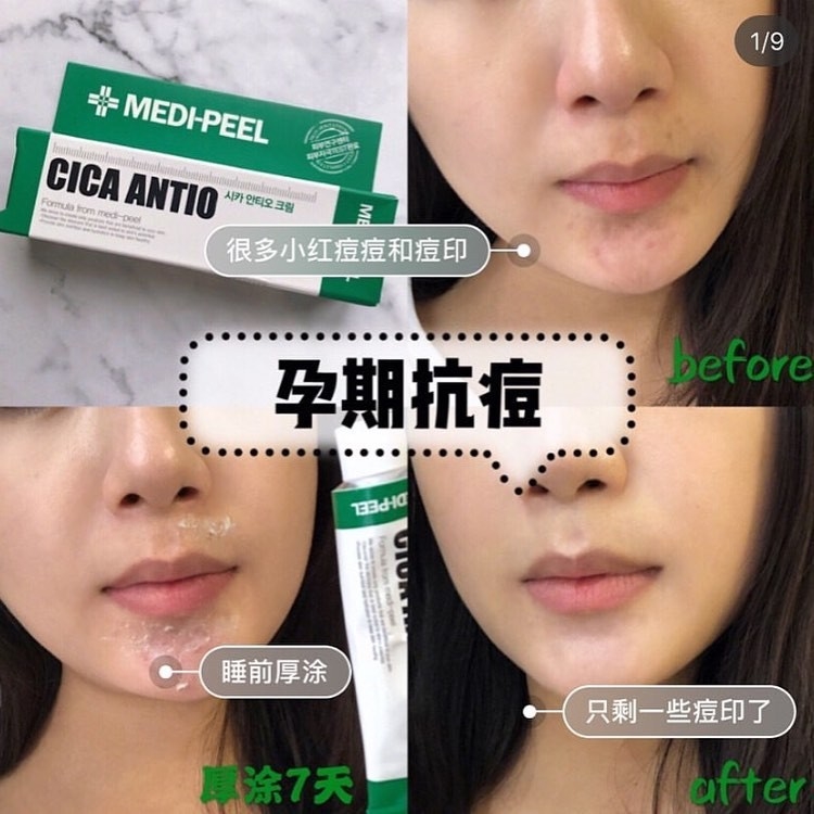 Medi-Peel Cica Antio Cream 30mL สูตรซิก้า สำหรับผิวเป็นสิว ผิวขาดความชุ่มชื้น ช่วยให้ผิวเก็บกักความชุ่มชื้นได้ดี กระจ่างใส เหมาะกับผิวแพ้ง่าย มีปัญหาสิว