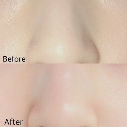 สูตรใหม่ Porenice Mint ยางลบมหัศจรรย์ ช่วยดูดซับสิ่งสกปรกบนรูขุมขนบริเวณจมูก ทำให้ให้สิวเสี้ยนลดลงอย่างเห็นได้ชัด