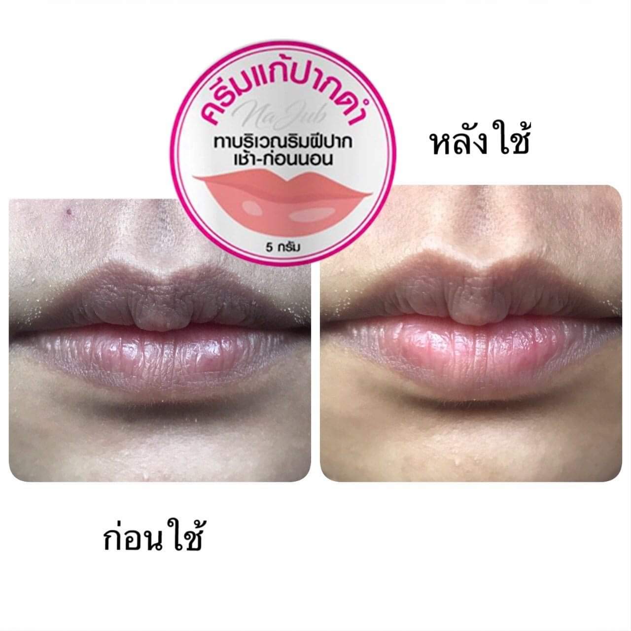 ครีมแก้ปากดำ คลินิค ลิปแก้ปากดำ