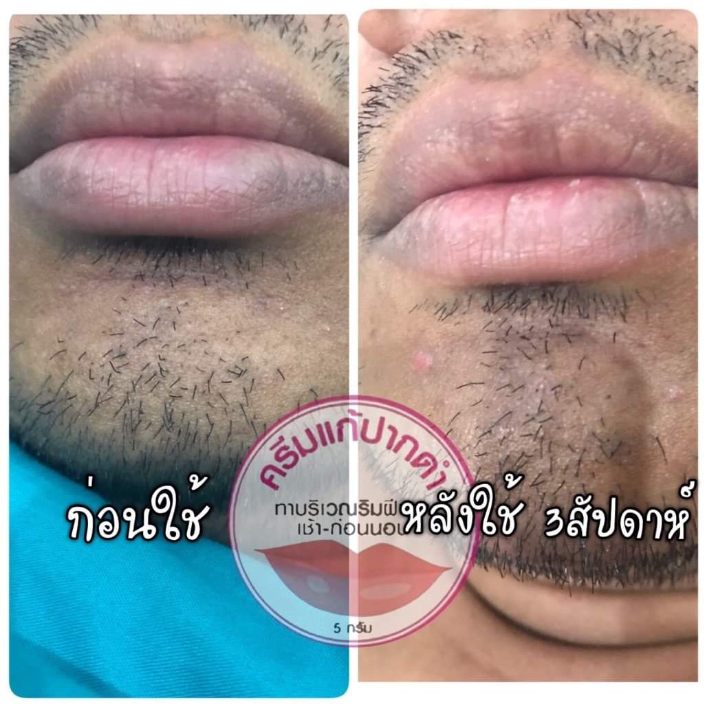 ครีมแก้ปากดำ คลินิค ลิปแก้ปากดำ