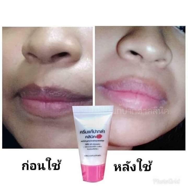ครีมแก้ปากดำ คลินิค ลิปแก้ปากดำ