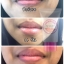 ครีมแก้ปากดำ คลินิค ลิปแก้ปากดำ